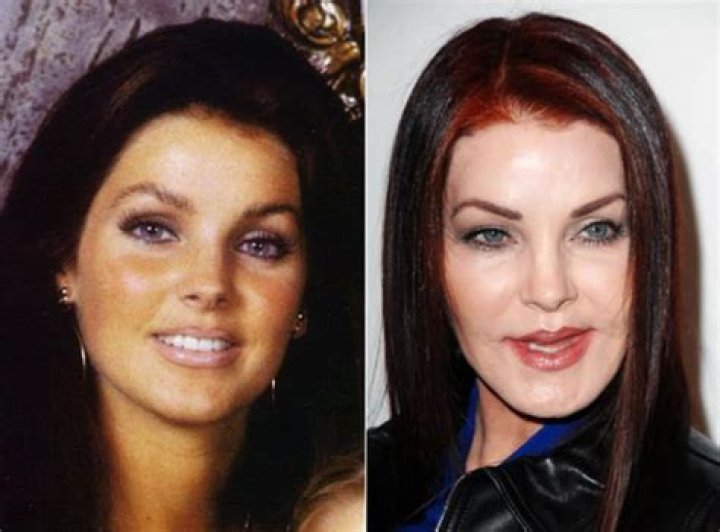 10 Cases of Celebrity Plastic Surgery Gone Wrong Page 3