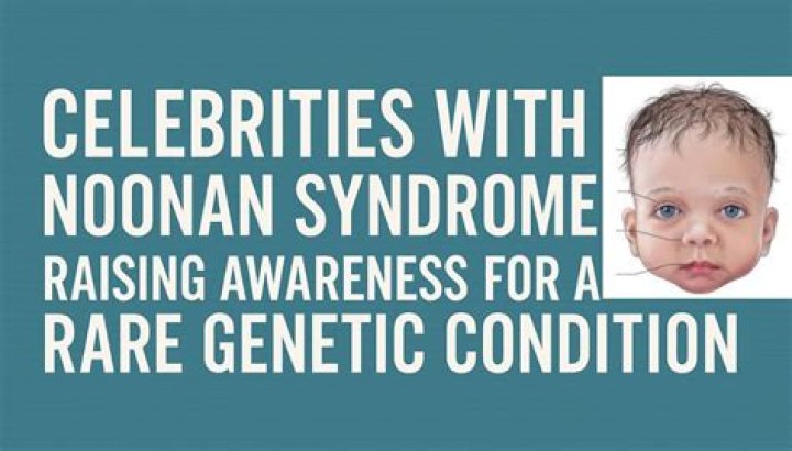 10 Celebrities With Noonan Syndrome You'll Be Surprised Who!