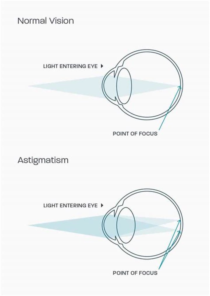 A Complete Guide to Astigmatism Symptoms, Causes, Diagnosis, and