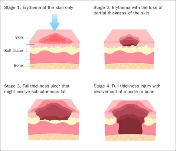 (A,B) Areas of mildly erythematous mucosa and multiple aphthous ulcers