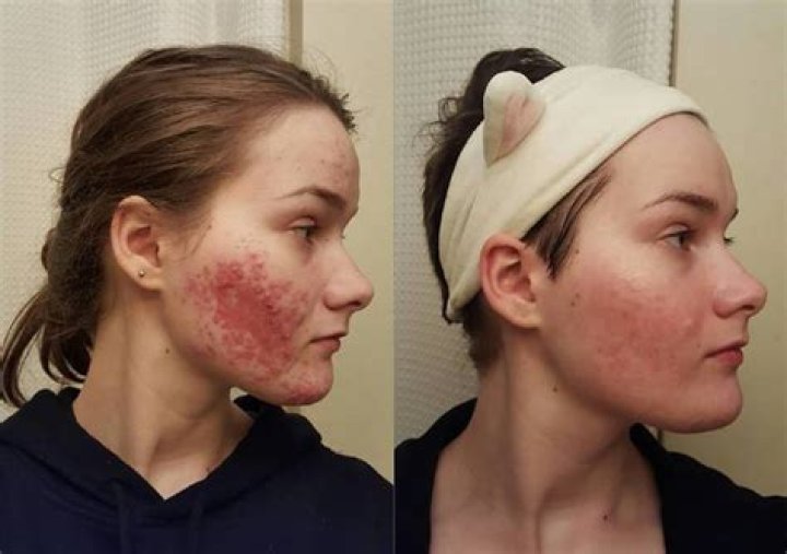 Accutane Before And After Bacne