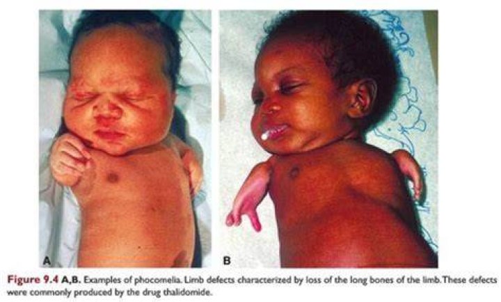 Accutane Birth Defects