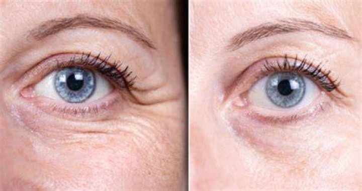 Achieve Youthful Radiance with Jelly Roll Botox Botox Brow Lift