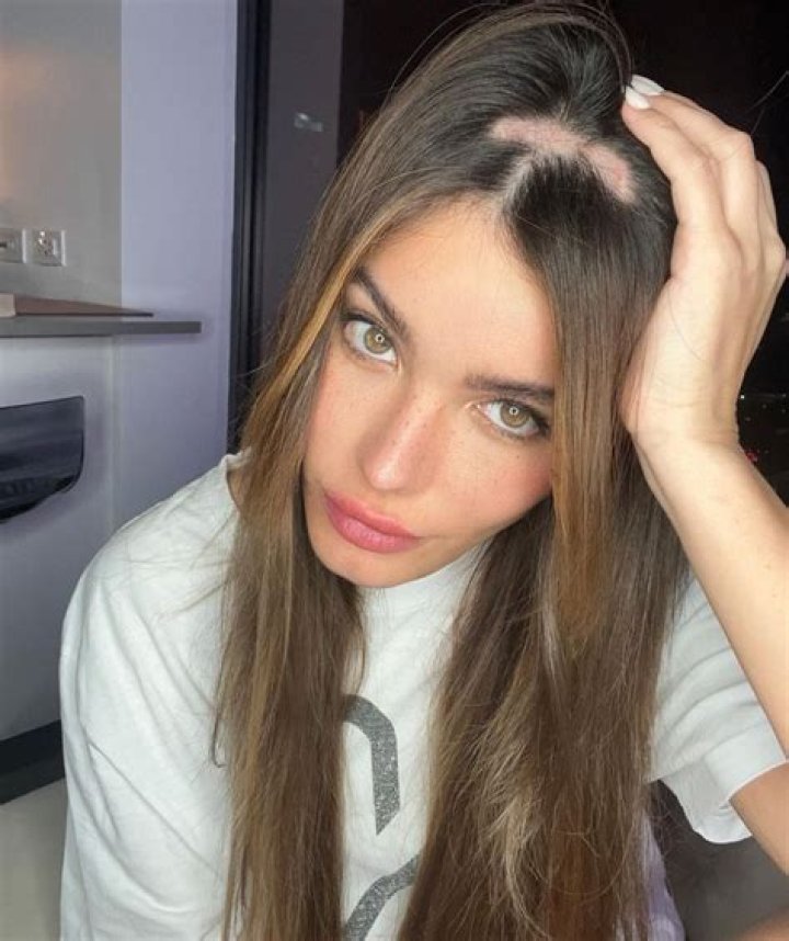 Aleska Génesis tiene alopecia por qué se le está cayendo el pelo a la