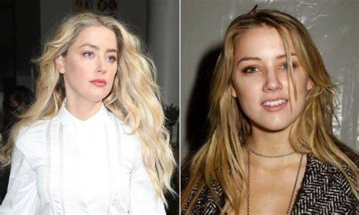 Amber Heard Plastic Surgery Analysis Before and After Transformation