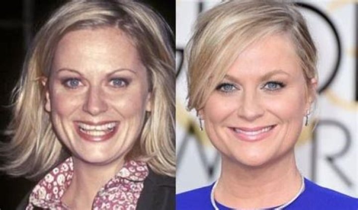 Amy Poehler plastic surgery (11) Celebrity plastic surgery online