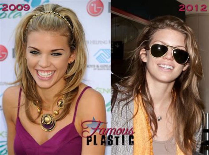 AnnaLynne McCord Plastic Surgery Before and After