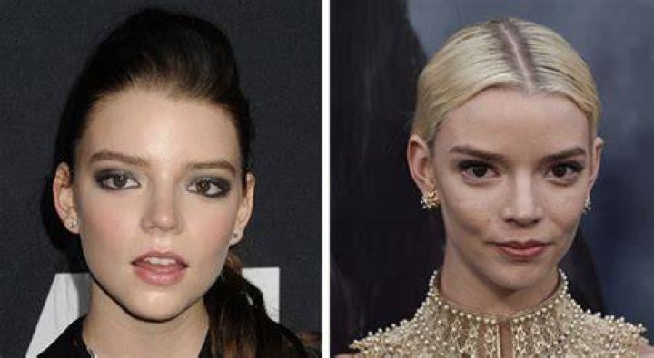 Anya TaylorJoy Before Plastic Surgery Botox, Nose Job, Lips, and