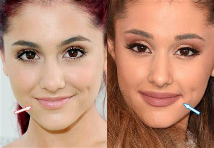 Ariana Grande Lip Fillers Before and After Photo Compare Plastic