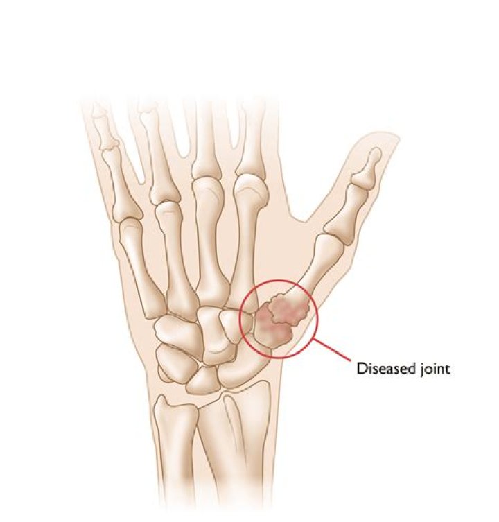 Arthritis at the base of the thumb Hand Therapy Group