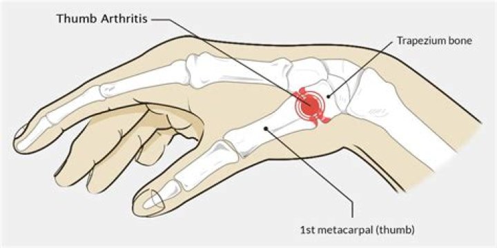 Arthritis of the Thumb Symptoms & Treatment Singapore Sports and