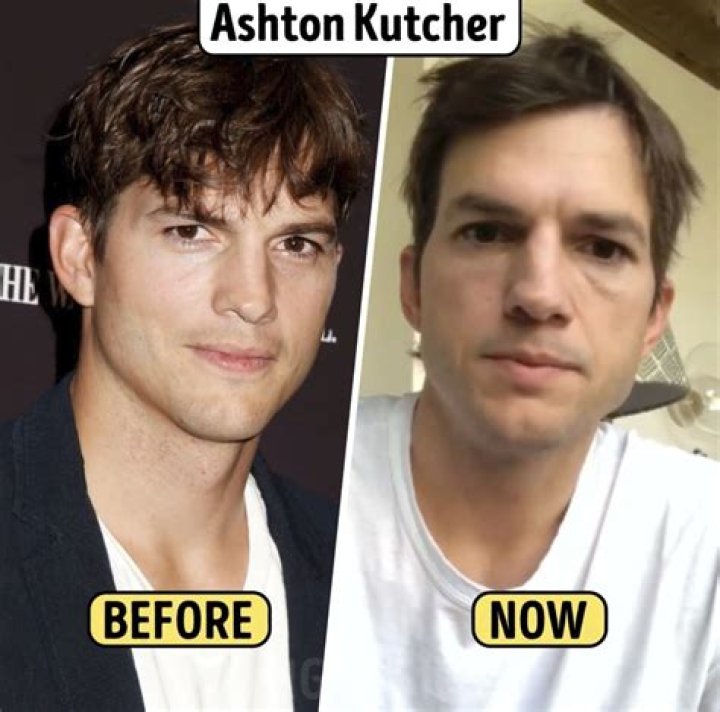 Ashton Kutcher Nose Job Plastic Surgery Before and After Celebie
