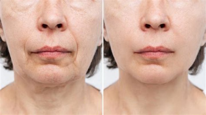 Before and After Facetite Photo Gallery Brent Moelleken M.D.