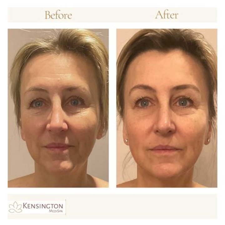 Before and After Medispa Visit Here For It All blog