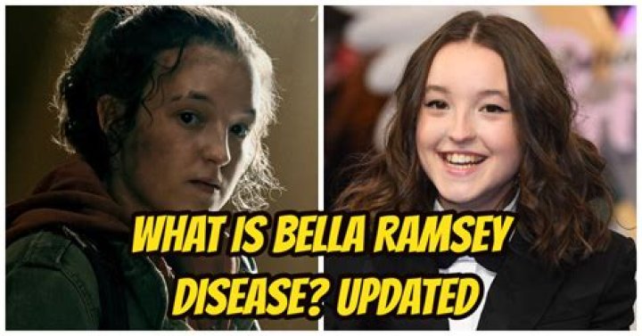 Bella Ramsey Disease Is She Sick? Is Her Face Hereditary?