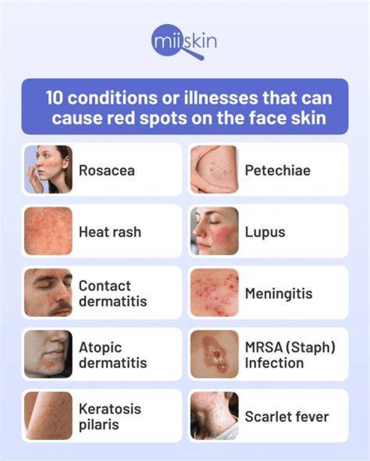 Bella Ramsey Face Condition: Causes, Symptoms, And Treatment