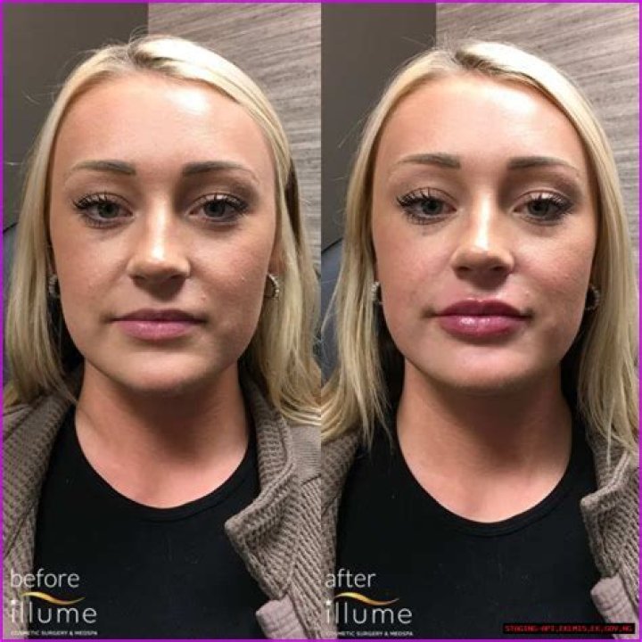 Beth Dutton Lip Injections Surgery Before And After Photos