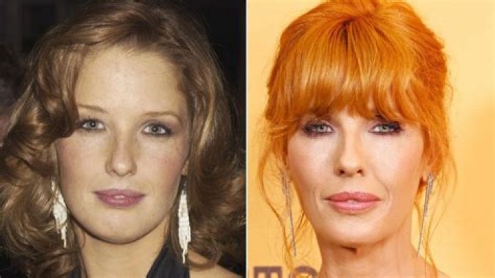 Beth Dutton Lip Surgery Before And After Photos