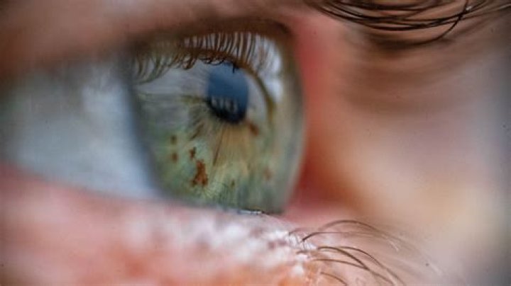 Billy Eichner's Eye Explained: Surprising Insights Revealed