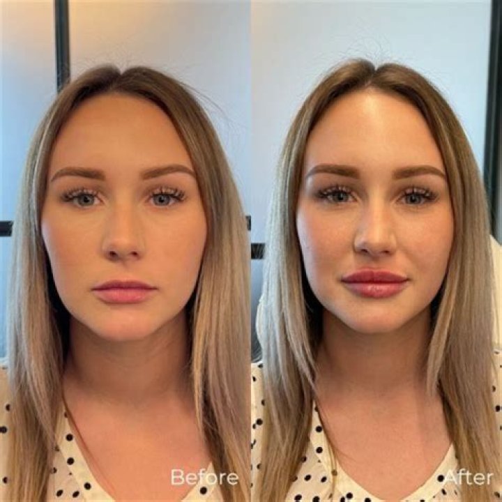 Botox And Lip Filler Before And After Photos