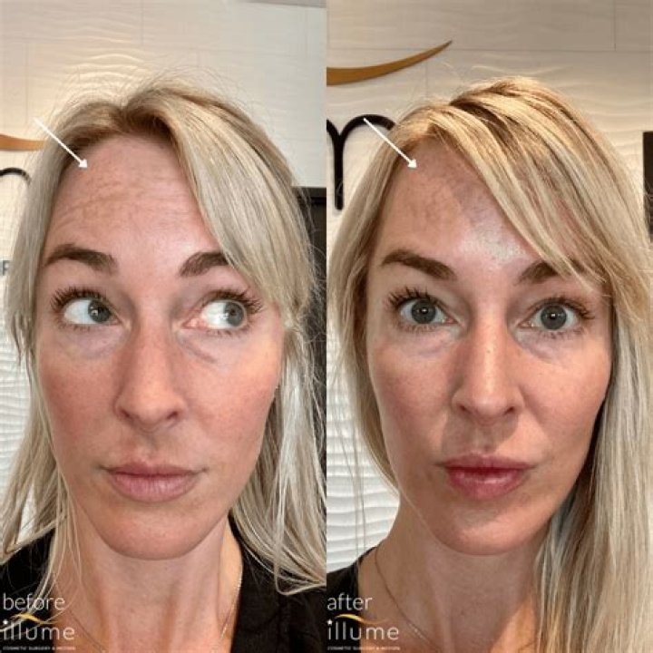 BOTOX&reg; Cosmetic Before & After Photos Patient 47 Houston, TX