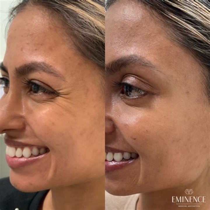 BOTOX&reg; Cosmetic Results Princeton, Montgomery NJ Eminence