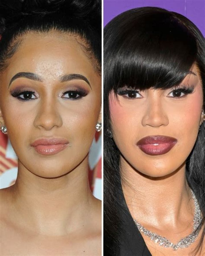 Cardi B Before and After Plastic Surgery Botox, Facelift, Body
