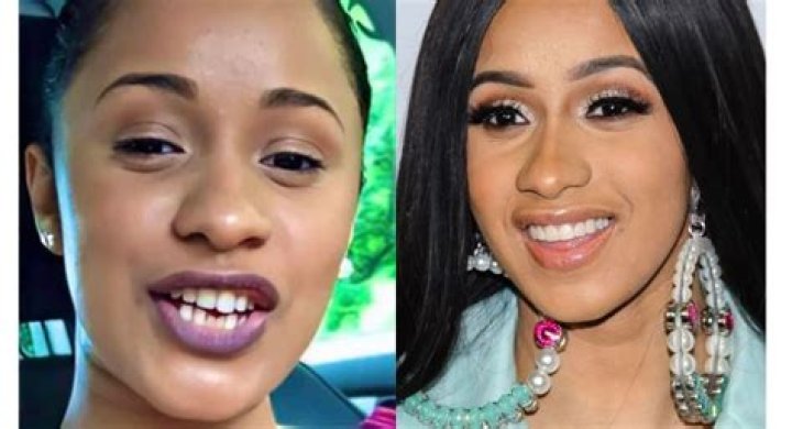 Cardi B Teeth Before And After Old Smile Vs New Empire BBK