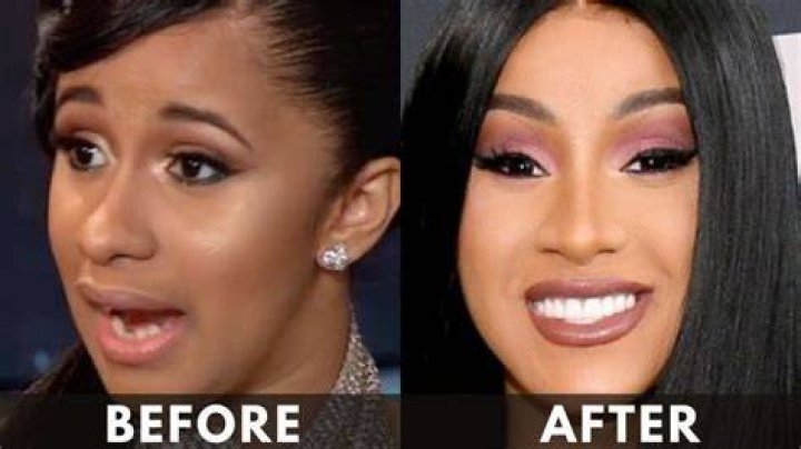 Cardi B Teeth Transformation Surgery, Cost, Before and After