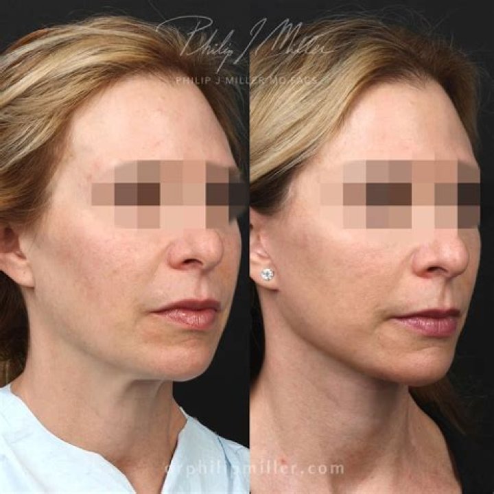 Carol Plastic Surgery Facelift, Botox Before and After Photos