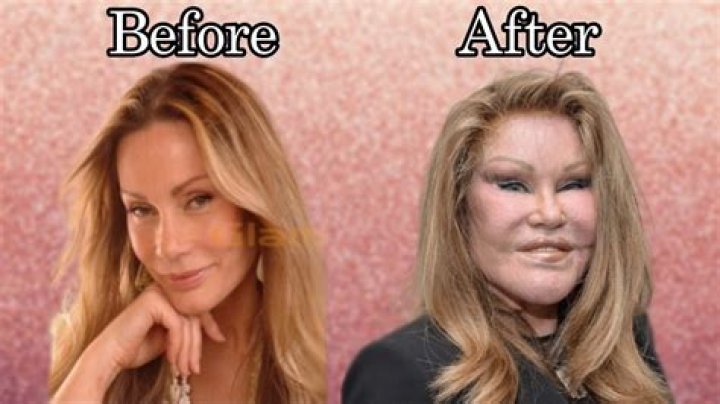 Catwoman Plastic Surgery Before And After
