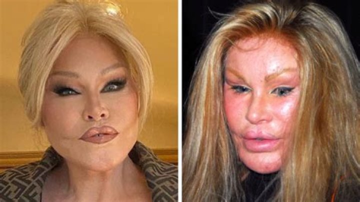Catwoman Plastic Surgery From Bad To Worse