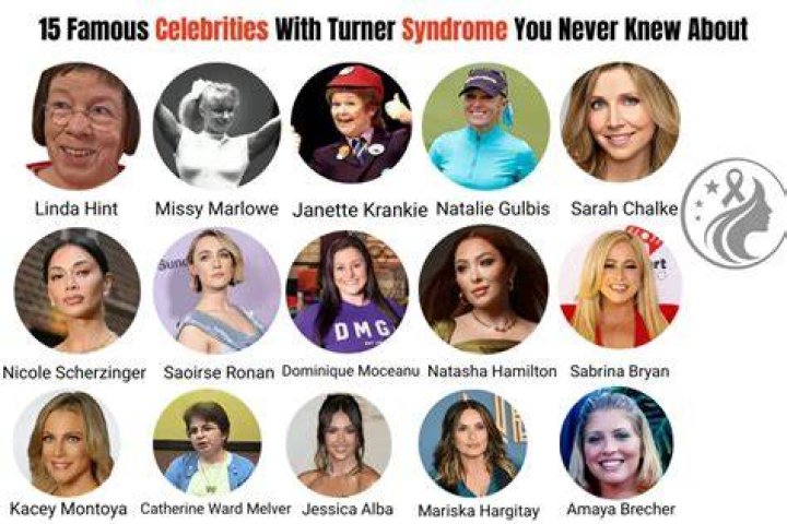 Celebrities With Turner's Syndrome Syndrome Turner Extraoral Features