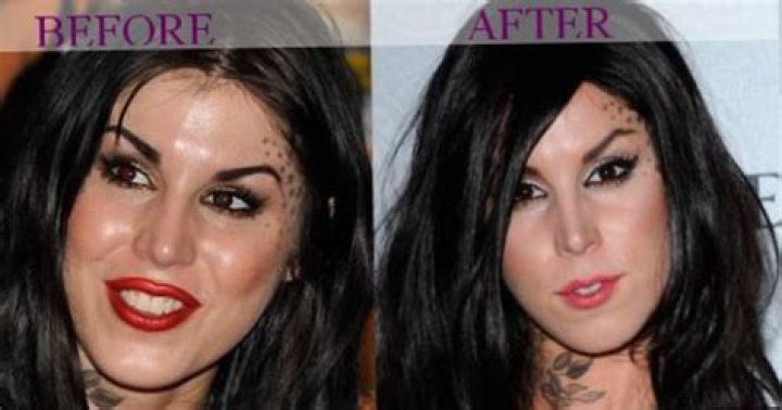 Celebrity Kat Von D plastic surgery, photos, video