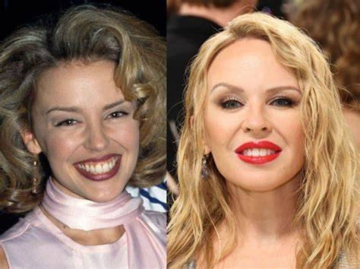 Chatter Busy Kylie Minogue Plastic Surgery