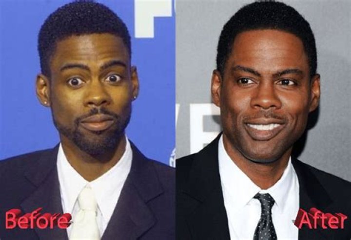 Chris Rock Before And After Plastic Surgery celebrity plastic surgery