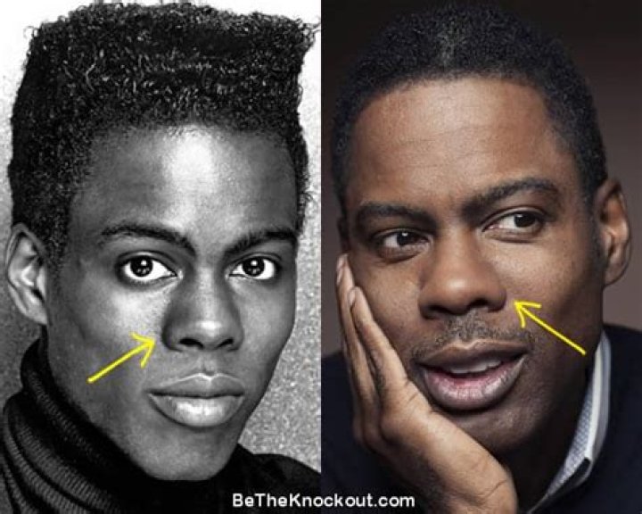 Chris Rock Plastic Surgery Nose Job, Lip Fillers and Botox
