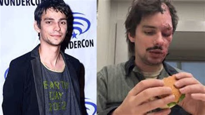 Devon Bostick Face Injury, What Happened to Devon Bostick's Face