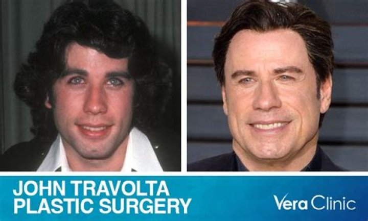 Did John Travolta Have Plastic Surgery? Reddit Contrasts John Travolta