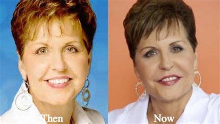 Did Joyce Meyer have Plastic Surgery? Joyce Meyer Before and After News
