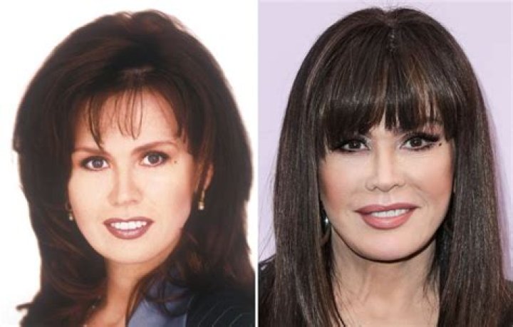 Did Marie Osmond Get Plastic Surgery? Transformation Photos