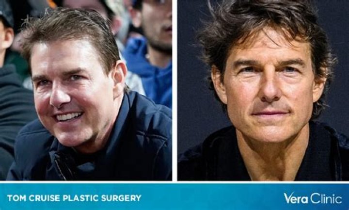 Did Tom Cruise Have Plastic Surgery? (Before & After Photos)