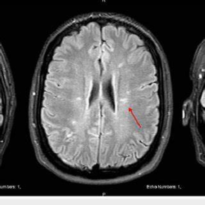 Do mini strokes show up on MRI?