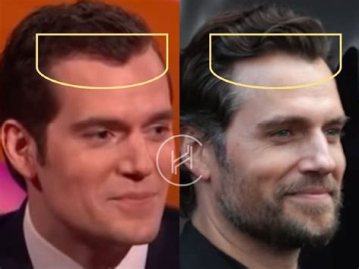 Does Henry Cavill Have Cancer? Sickness And Health Update