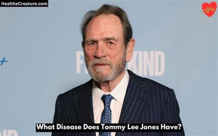Does Tommy Lee Jones have cancer?