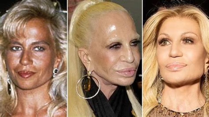 Donatella Versace autrefois &eacute;talon de la beaut&eacute;, aujourd'hui gonfl&eacute;e