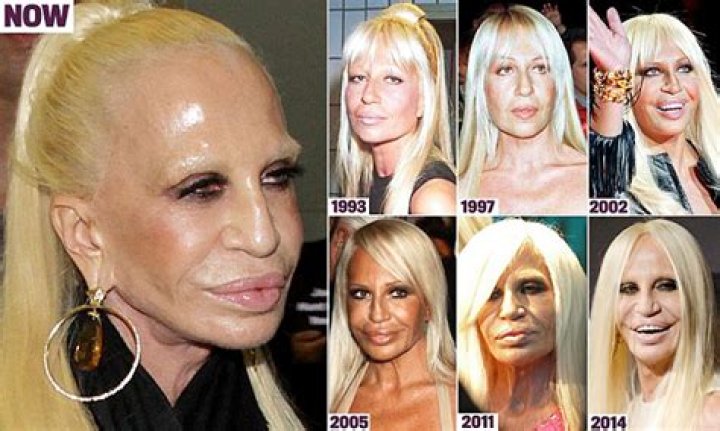 Donatella Versace Before and After Plastic Surgery