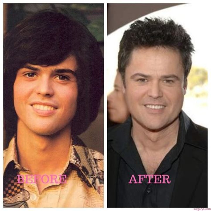 Donny Osmond Plastic Surgery Is Know All About the Osmonds&rsquo; Brother