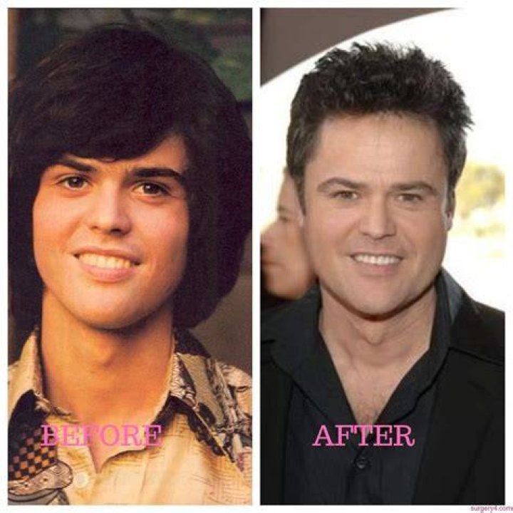 Donny Osmond Plastic Surgery Photos [Before & After] ⋆ Surgery4