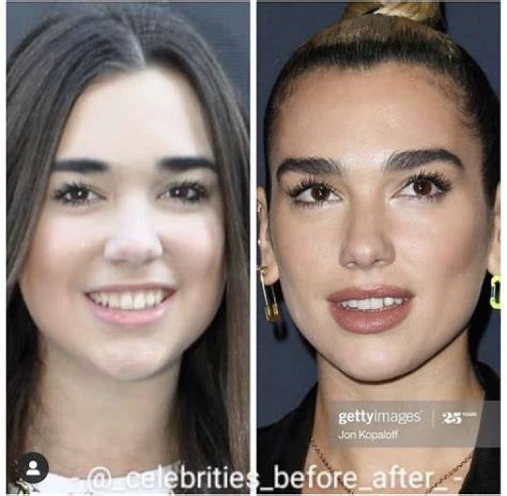 Dua Lipa Nose Job Did She Underwent Surgery? Before And After